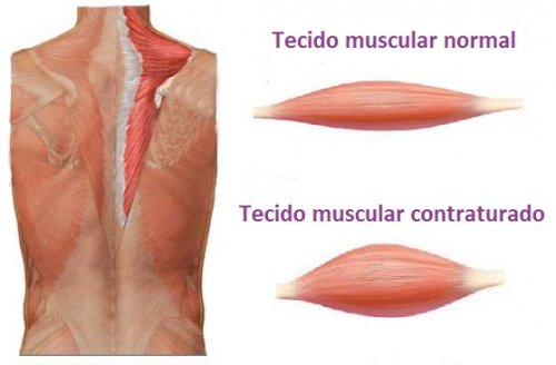 Contratura Muscular Nas Costas E Lombalgia Alessandra Faria Fashion Contratura Muscular Nas Costas E Lombalgia Alessandra Faria Fashion