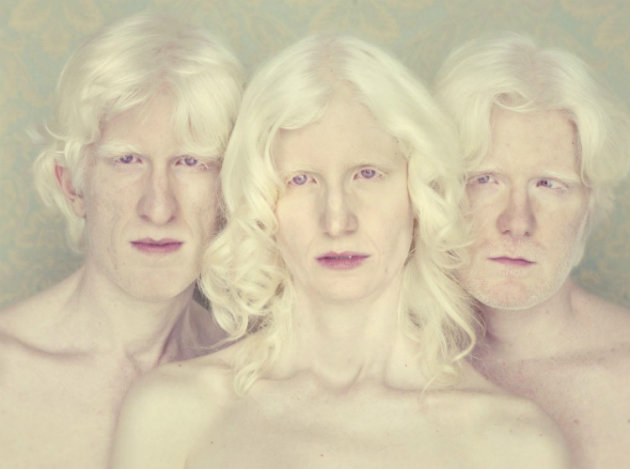 albinismo-pessoas-albinas 4