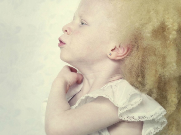 albinismo-pessoas-albinas-criança