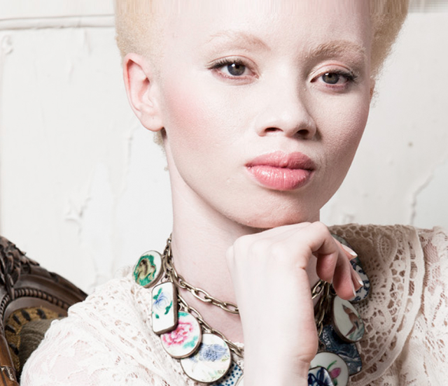 albinismo-pessoas-albinas-modelo-Thando Hopa