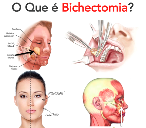 bichectomia-cirurgia-de-reducao-das-bochechas-alteração-do-formato-do-rosto2