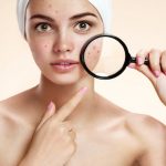Mitos e verdades sobre a acne!